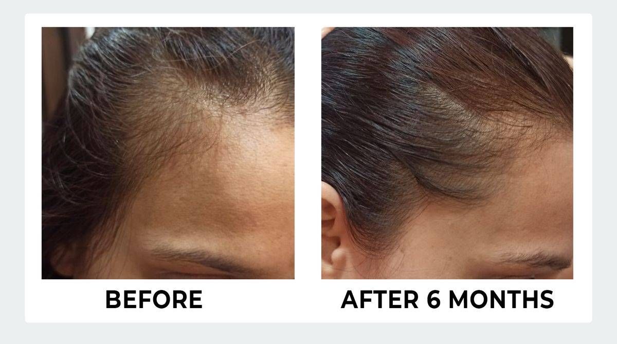 After struggling with hair loss for years, I tried an Ayurvedic hair care regimen. It's been a slow process, but my hair is definitely growing back, and it's much stronger.