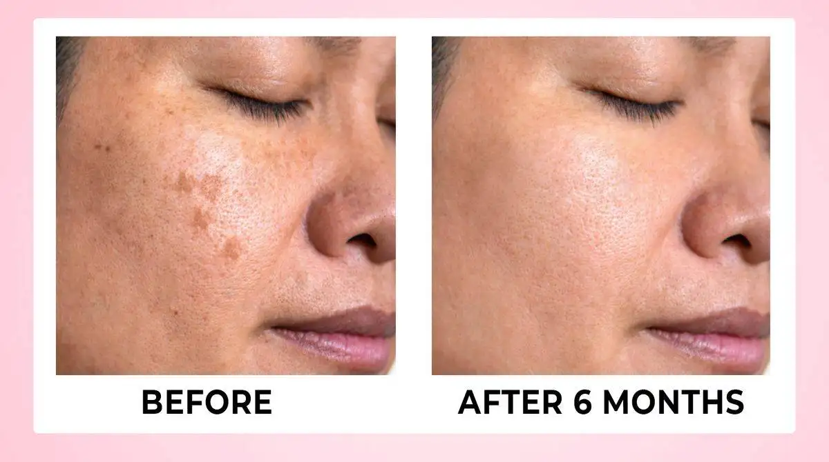 Skin Renewal Tablets For Clear Glowing Skin - 60 veg Tabs 13 BEFORE AFTER 01