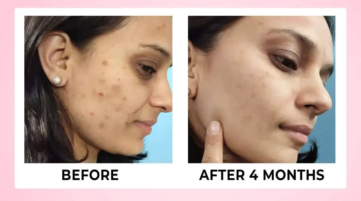 Skin Renewal Tablets For Clear Glowing Skin - 60 veg Tabs 12 BEFORE AFTER 02