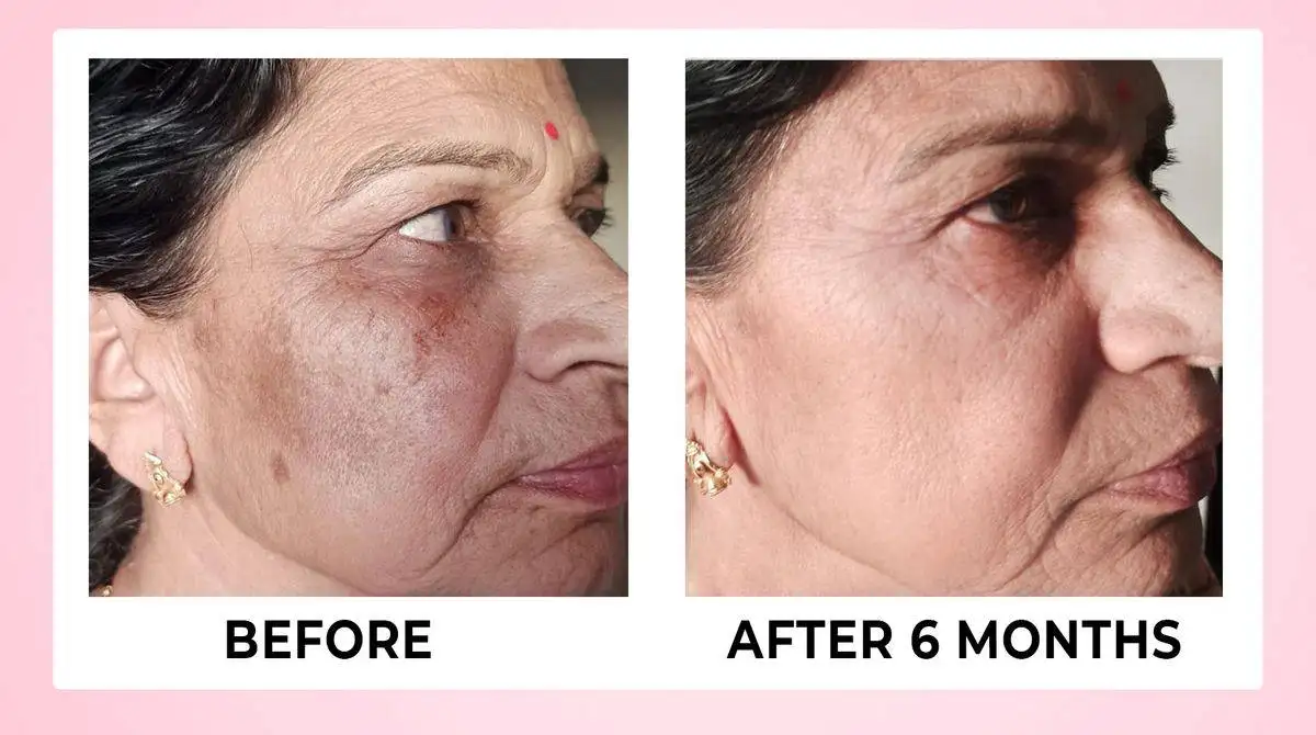 Skin Renewal Tablets For Clear Glowing Skin - 60 veg Tabs 14 BEFORE AFTER 03