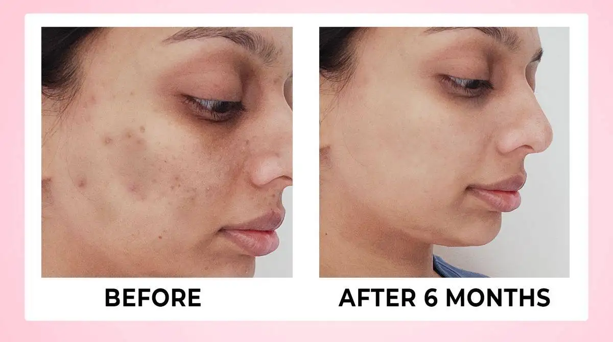 Skin Renewal Tablets For Clear Glowing Skin - 60 veg Tabs 15 BEFORE AFTER 04